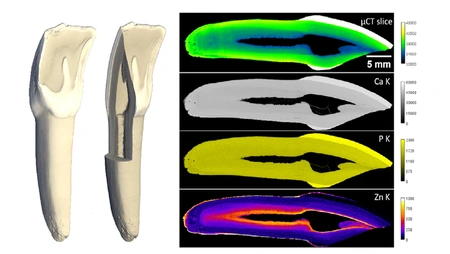 CT-Bilder von Zähnen und Mineralverteilung darin