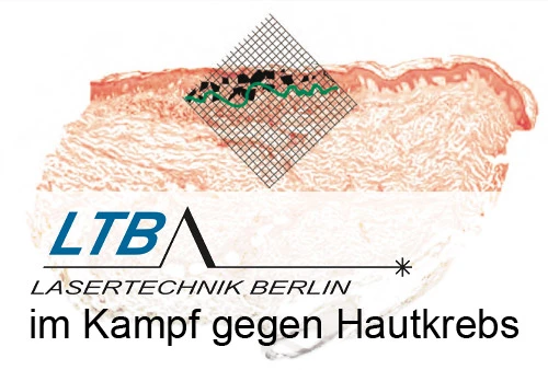 Bild: © LTB Lasertechnik Berlin GmbH